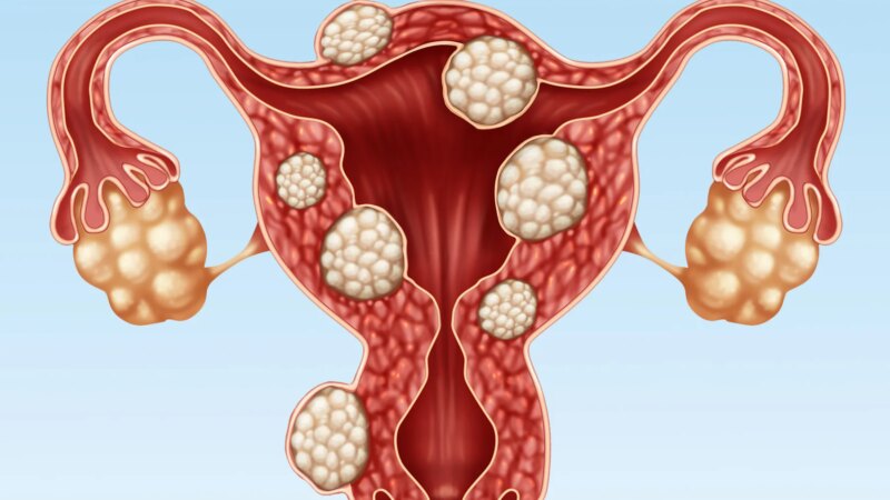 Why Are Uterine Fibroids Particularly Common in Black Women?