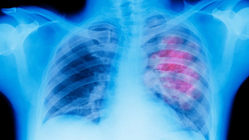 How Genes and Genetic Biomarkers Affect Lung Cancer