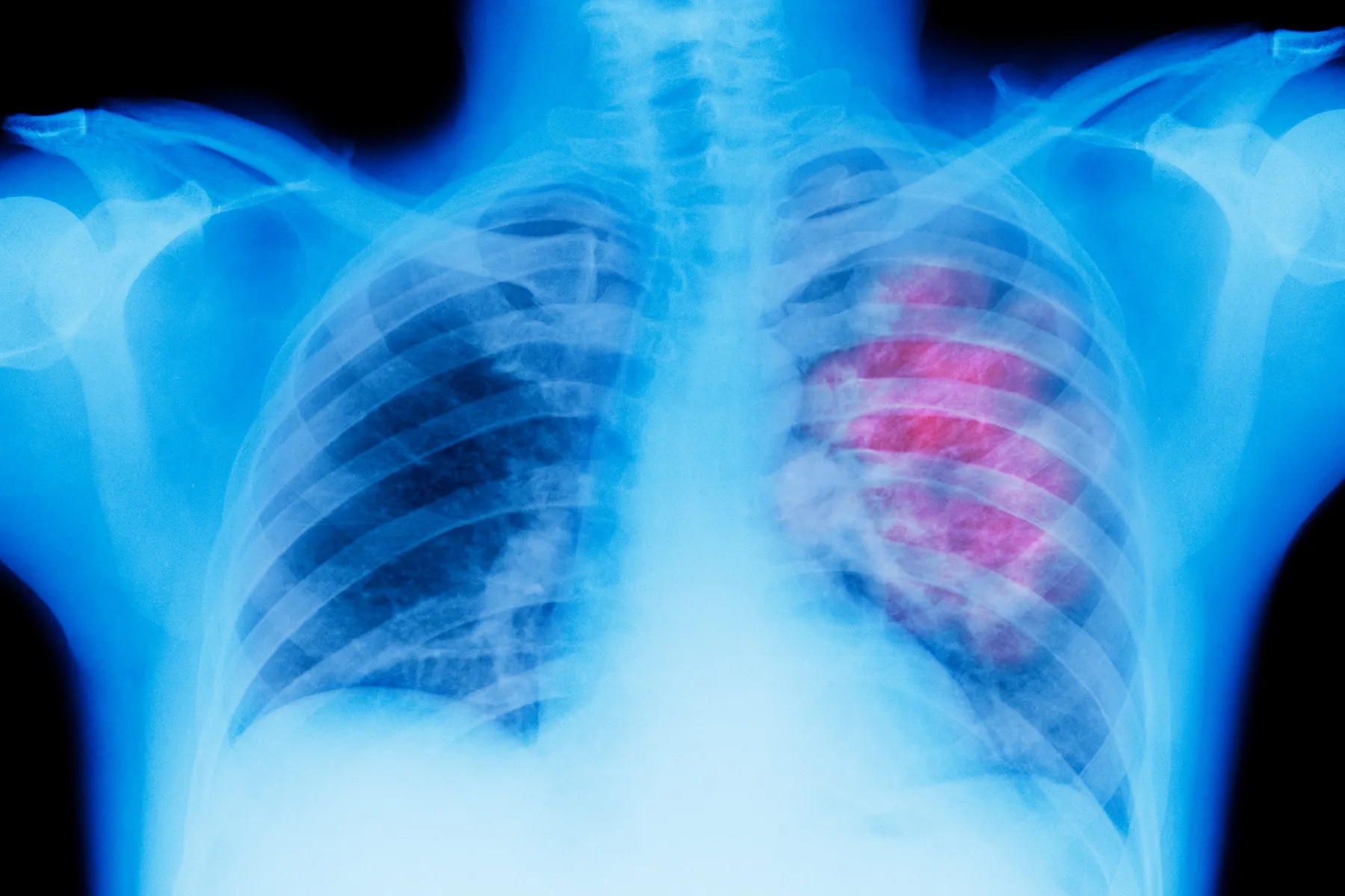 How Genes and Genetic Biomarkers Affect Lung Cancer