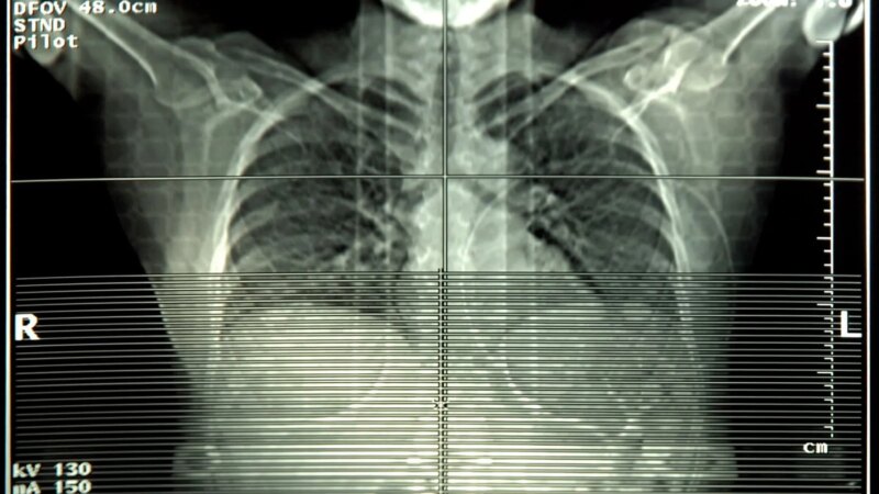 Surgery Beats Targeted Radiation for Early Stage Lung Cancer