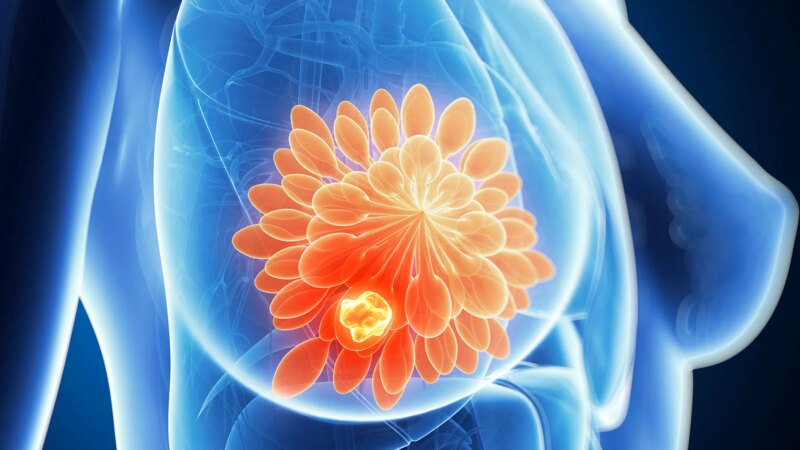 Some Breast Cancer Patients May Safely Forgo Chemotherapy