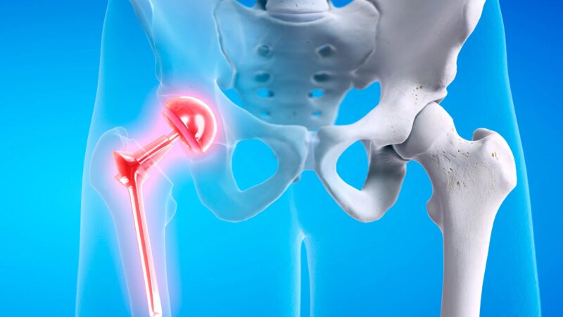 Few Age Limitations for Joint Replacement