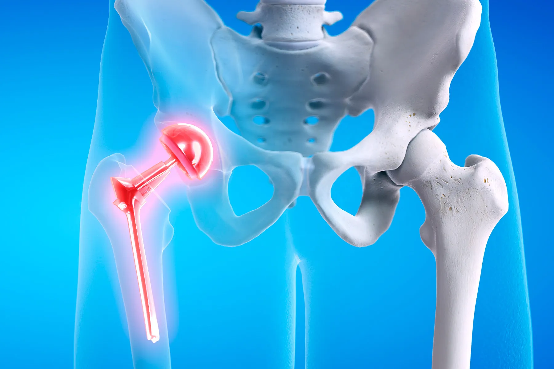 Few Age Limitations for Joint Replacement