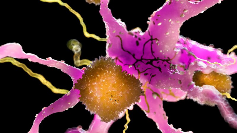 FDA Approves New Drug to Slow Alzheimer’s Disease