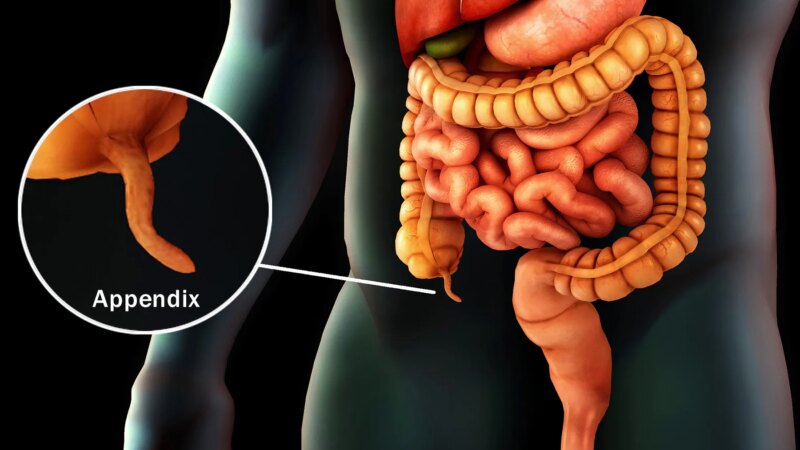 Tiny Organ, Long-Lasting Pain: Mystery of Chronic Appendicitis