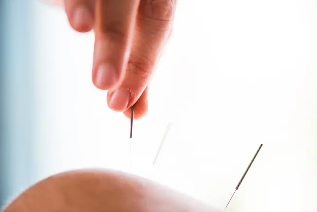 More Parents Turning to Acupuncture for Kids’ Pain, Anxiety