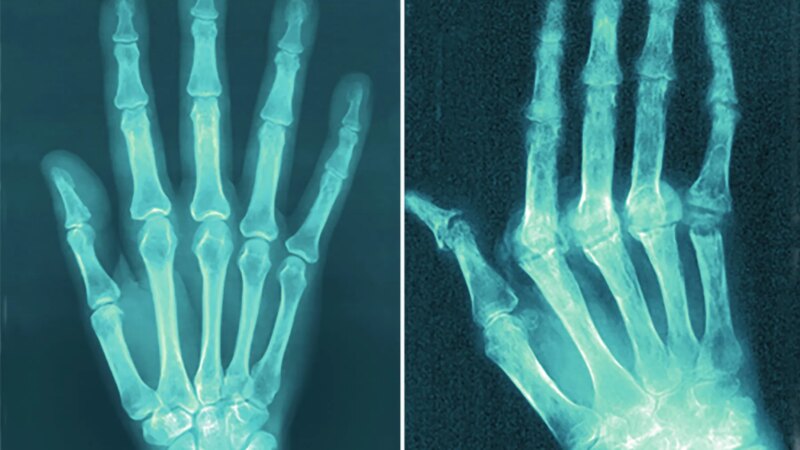 FDA Warns of Hidden Ingredients in Arthritis, Pain Products