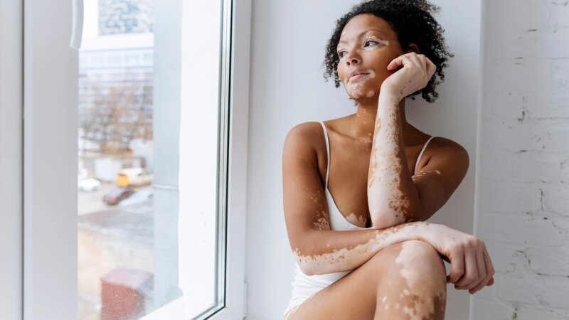 Vitiligo: Facing the Doubt