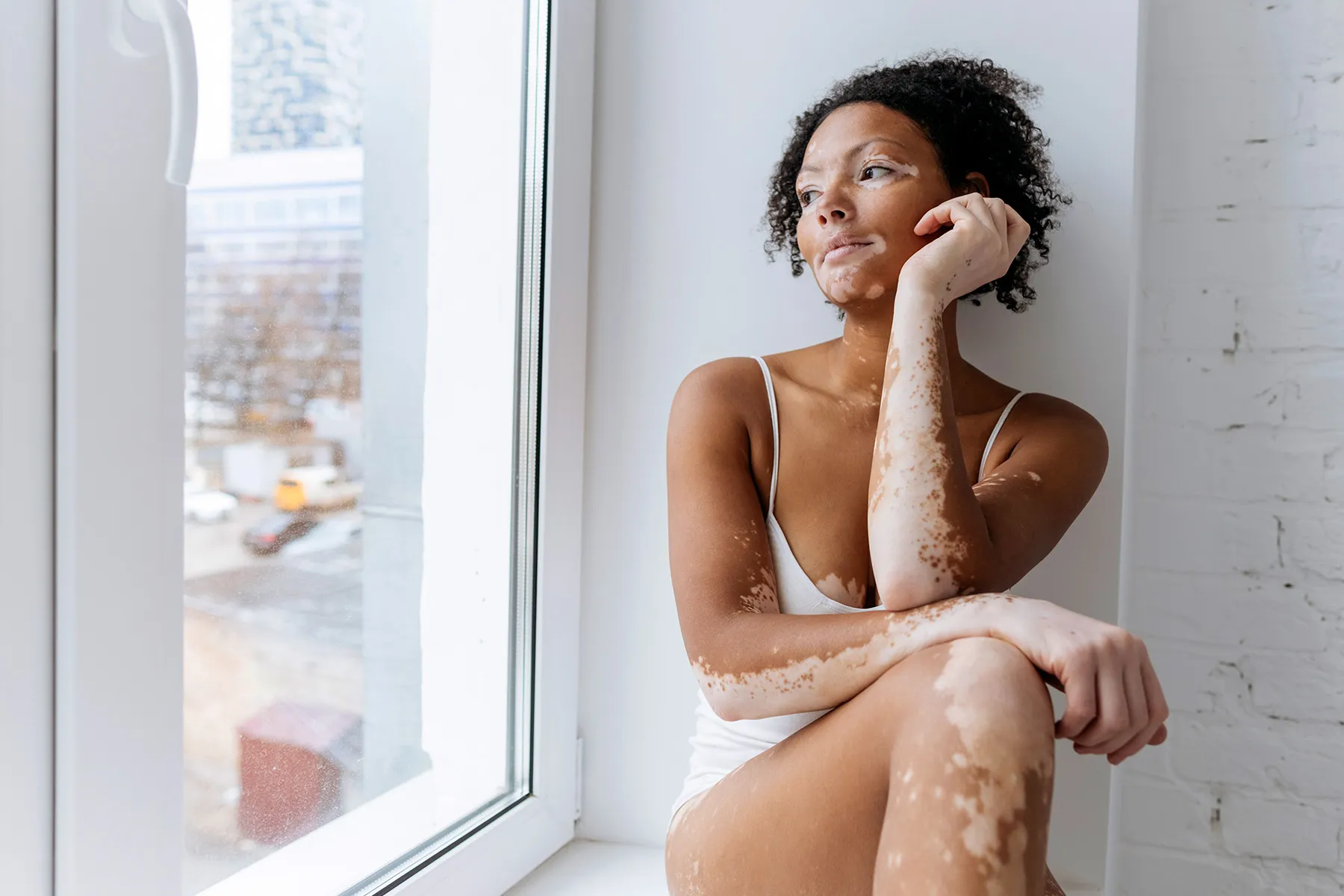 Vitiligo: Facing the Doubt