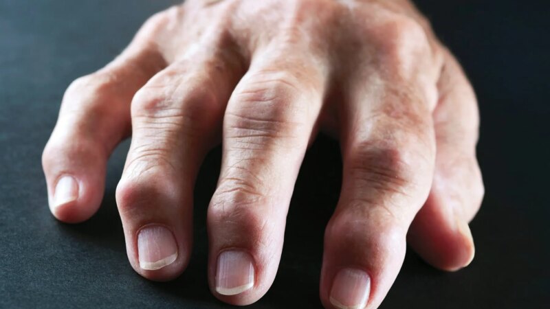 Doctors Strive for Quicker Diagnosis of Rheumatoid Arthritis