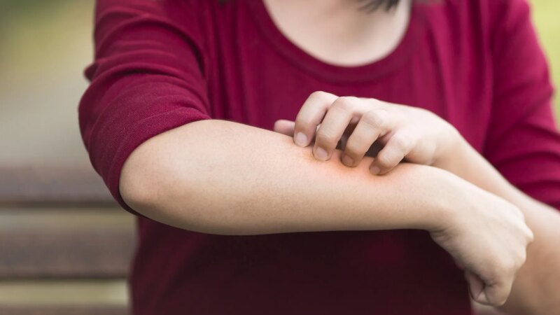 Atopic Dermatitis: Daily Life