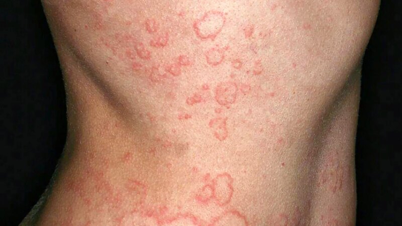 Chronic Spontaneous Urticaria: What to Know