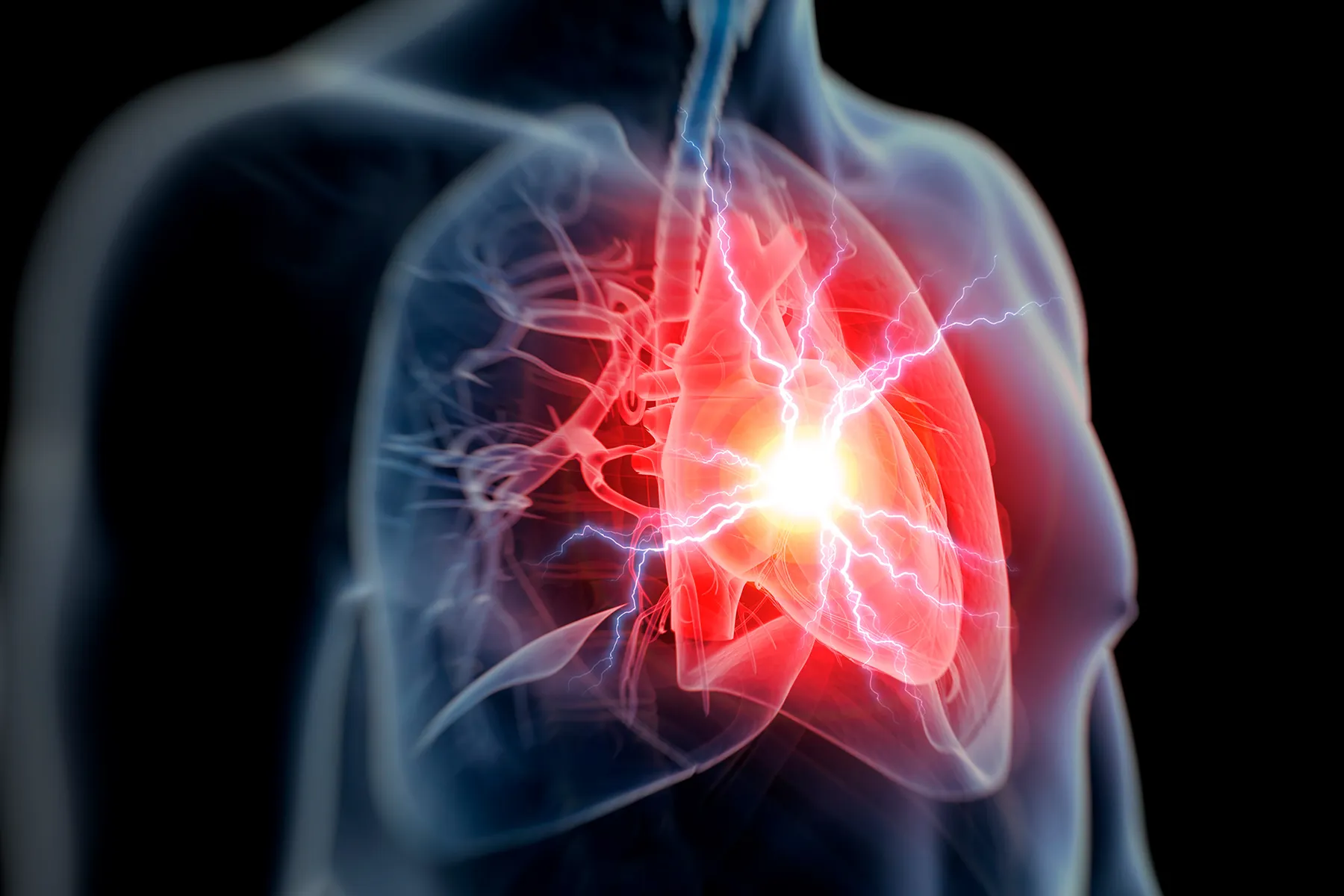 Chest Pain and Other Signs