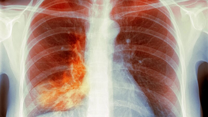 ‘White Lung’ Pneumonia – What You Need to Know