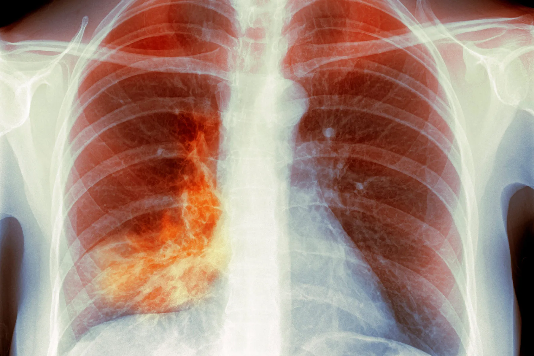 ‘White Lung’ Pneumonia – What You Need to Know