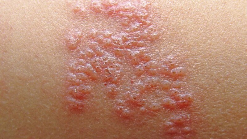 Pandemic and Costs Limited Use of Shingles Vaccine