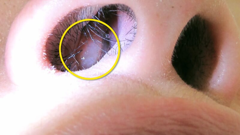 Why Do I Have Nasal Polyps?