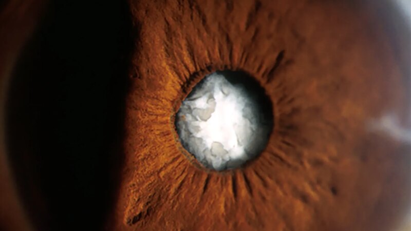 Cataract Surgery Tricky for Those With Past Radial Keratotomy