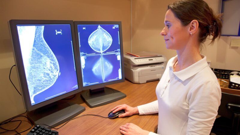 Are Transgender People at Risk of Breast Cancer?